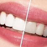 whitening teeth 